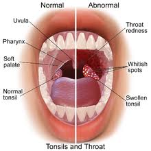 Image result for gale ke tonsil