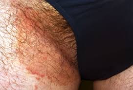 Jock itch is very common around the world and is more of a problem in warm, moist regions, as the fungus thrives. Pictures Of Fungal Skin Infections