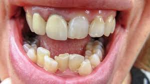 Maybe you would like to learn more about one of these? Crooked Teeth Causes Concerns And How To Straighten