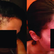pdf hair loss in a female patient