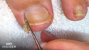 how toenails are professionally cleaned