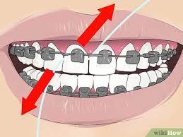 Take your time and follow along with the best form for the procedure! 4 Ways To Floss With Braces Wikihow