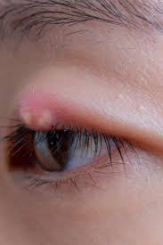 7 ways to treat or get rid of a stye