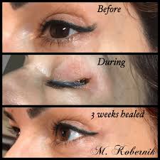 permanent cosmetics removal