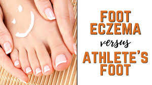types of foot eczema vs athlete s feet