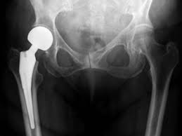 partial hip replacement physiopedia