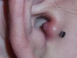 swollen tragus piercings causes and