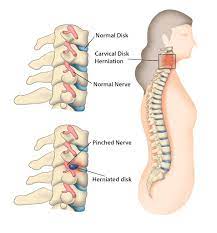 can a pinched nerve affect your body s