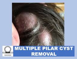 pilar cysts what are multiple pilar