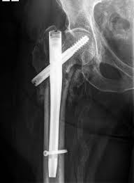 gamma nail after hip fracture fixation