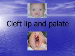 cleft lip and cleft palate pdf د احمد