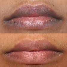 all about laser lip lightening effects