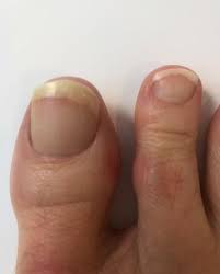 can toenail fungus spread to other