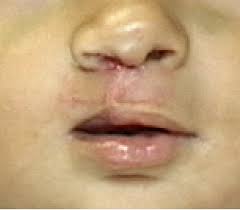 unilateral cleft lip hypertrophic scar