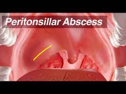 peritonsillar abscess identification