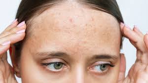 what causes forehead acne how can you