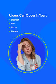 what is an ulcer types symptoms effects
