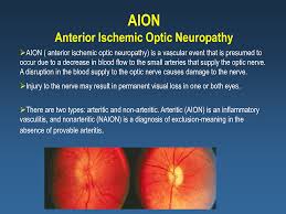 Approximately 6000 new cases occur annually in the united states. Anterior Ischemic Optic Neuropathy Pale Disc Dots In Retina Flame Hemorrhages2 Medicalimages