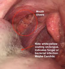 mouth ulcer or canker sore