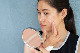 acne scars worse