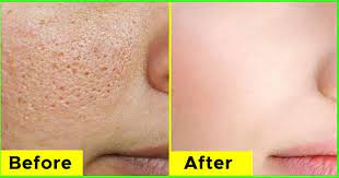 natural home remes for open pores