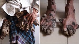 There is a genetic factor behind it, and this disease is considered very rare. Asia News Bangladeshi Tree Man Requires More Surgeries On Growths
