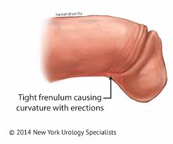 ألم القضيب أثناء ممارسة الجنس - Adult Circumcision in NYC