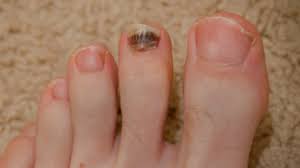 toenail problems causes symptoms and