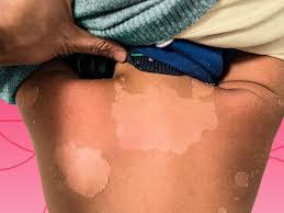 inal rash causes treatments