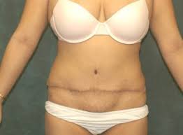 abdominal protrusion after tummy tuck