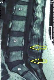 mri spine showing disc bulge at l3 l4