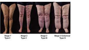 lipedema treatment