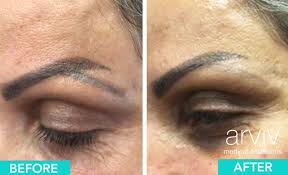 permanent makeup removal in ta fl