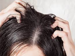 expert tips to manage an itchy scalp
