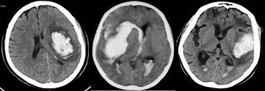 Tac cerebral con hematoma intraparenquimatoso por rotura de malformación arteriovenosa. 2020 Tema V Hemorragia Cerebral