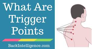 what are myofascial trigger points
