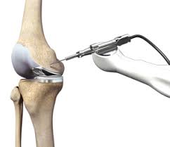 mako robotic isted knee replacement