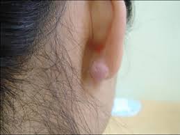 piercing p vs keloid how to tell