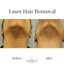 laser hair removal treatment mt