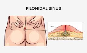 t for pilonidal sinus foods to