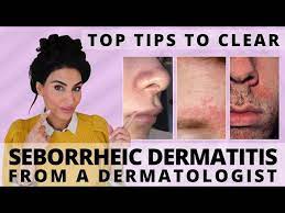 top tips to clear seborrheic dermais