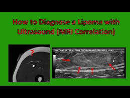 lipoma ultrasound characteristics