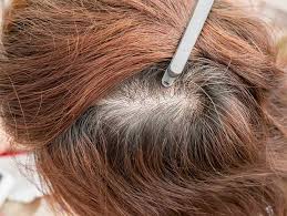 Celiac disease can be associated with iron deficiency, which triggers hair loss. Thinning Hair Can Have Myriad Causes University Health News