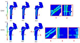 in silico finite element modeling of