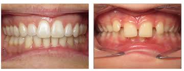 An overbite is a common dental condition that. Can Invisalign Actually Fix An Overbite Impact Orthodontics