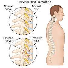 cervical disc herniation aftercare