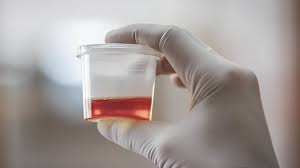 what causes blood in urine hematuria