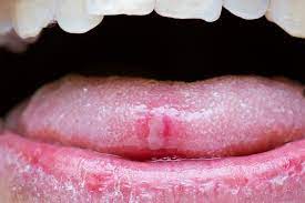 what causes canker sores the new