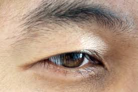 questions about droopy eyelid surgery