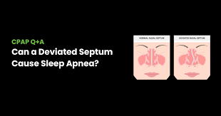 is your deviated septum causing your